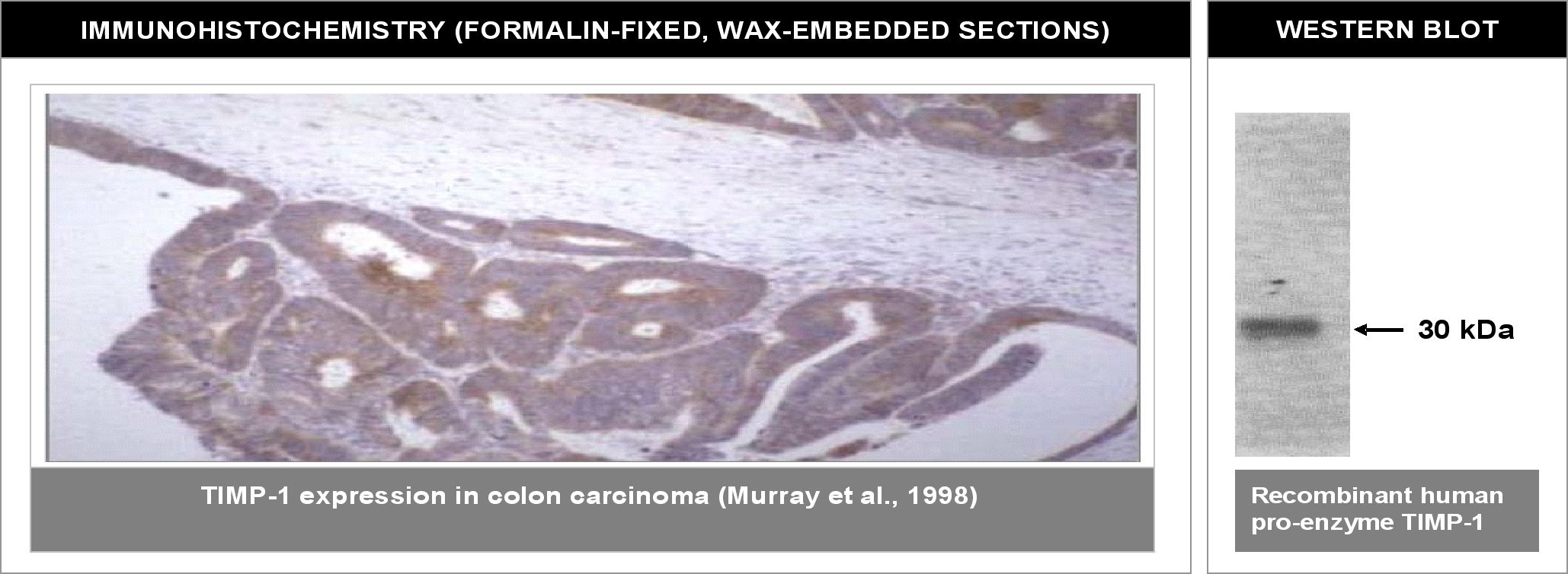 "
Left: Immunohistochemical staining of human colon carcinoma tissue using TIMP-1 antibody (Cat. No. X2058M).
Right: Western blot using TIMP-1 antibody against recombinant human TIMP-1 proenzyme (400 ng/lane)."